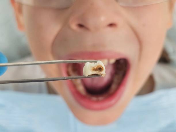 Best Emergency Root Canal Treatment in Jamestown, NC